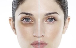 Bạn bối rối vì quầng thâm mắt, vậy hãy xem chúng xuất hiện như thế nào?