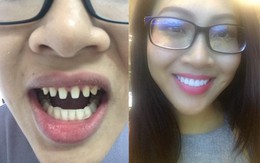 Nếu tháo hết răng sứ, liệu có ai dám nhìn Nguyễn Thị Thành khi cười?