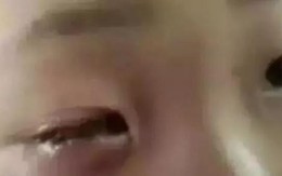 Táy máy nghịch gói hút ẩm trong hộp bánh, bé trai không may bị mù 1 mắt
