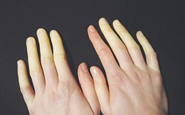 Đã mặc đồ ấm mà chân tay vẫn tê bì, lạnh cóng: Đừng chủ quan, coi chừng bệnh hiểm