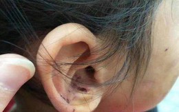 Bé gái 6 tuổi bị mẹ đẻ ngược đãi dã man khiến mặt đầy vết thương, tóc rụng thành mảng lớn
