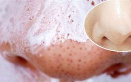 Cách trị mụn cám, mụn đầu đen với kem đánh răng siêu đơn giản