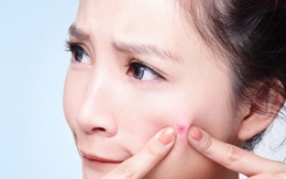 Chị em nặn mụn xong nhất định phải làm điều này để tránh nhiễm trùng và sẹo