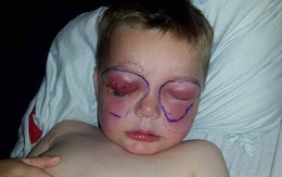 Chỉ sau một cú té, cậu bé 4 tuổi suýt mù và thậm chí mất mạng vì bị nhiễm vi khuẩn ăn thịt người