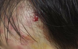 Hà Nội: Truy tìm nam thanh niên phóng mô tô tông bé gái 11 tháng trầy xước mặt rồi bỏ chạy