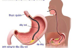 6 nhóm người có nguy cơ cao mắc ung thư dạ dày, đừng để khối u 'làm tổ' rồi mới đi khám