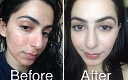 Lột da hóa học (Chemical Peel) – Nghe thì đáng sợ nhưng lại rất đáng thử