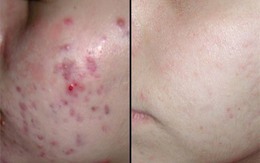Mụn loại nào cũng khỏi, hết thâm, da trắng mịn nhờ nồi nước này