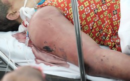 Nghi 'ma nhập' hai chị em bị thầy pháp dùng doi dâu đánh thâm tím toàn thân, khiến nguy kịch