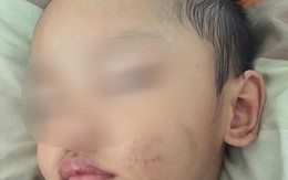 Bình Dương: Người mẹ trẻ tiếp tay cho chồng hờ, bạo hành con trai 2 tuổi phải nhập viện cấp cứu?