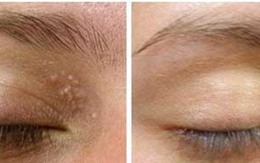 Với 2 ngàn đồng có ngay 2 cách trị mụn thịt quanh mắt "một đi không trở lại"