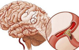 Bác sĩ BV Việt Đức: 6 bí quyết phòng ngừa giúp nguy cơ đột quỵ giảm rõ rệt