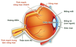 Tắc tĩnh mạch võng mạc do đâu?