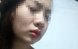 Mặt sưng phù vì làm má lúm đồng tiền tại nhà