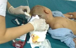 Thái Bình: Bé trai 3 tuổi đi học ở trường mầm non bị tụ máu 1/4 não phải mổ cấp cứu