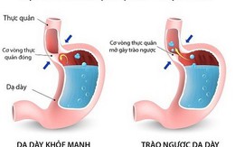 Trị đau tức ngực do trào ngược dạ dày - thực quản, thuốc gì?