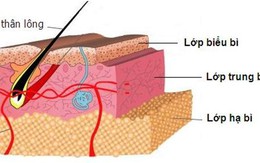 U tuyến mồ hôi và cách trị