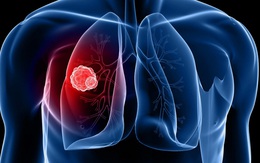 Để phát hiện ung thư phổi giai đoạn sớm không nên bỏ qua điều này
