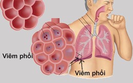 Căn bệnh gây tử vong hàng đầu ở trẻ, cha mẹ cần nhớ các dấu hiệu điển hình này