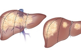Xơ gan nguy hiểm thế nào?