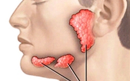 Xuất hiện dấu hiệu này bạn nên nghĩ đến ung thư tuyến nước bọt