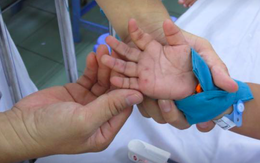 Bộ Y tế nói gì về biến đổi chủng virus dễ gây biến chứng nặng, tử vong ở trẻ mắc tay chân miệng?
