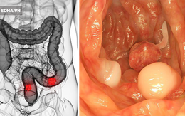 5 dấu hiệu điển hình cảnh báo khối u ung thư đại trực tràng đang phát triển "thần tốc"