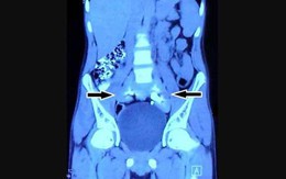 Chụp phim thấy 2 quả thận biến mất, chỉ còn 1… chiếc đĩa!