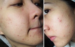Da sần sùi do mụn nhanh chóng láng mịn nếu sử dụng sản phẩm có chứa một trong các thành phần này