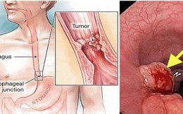 Phó giáo sư Nhật: 4 thói quen gây nguy cơ ung thư thực quản, ai mắc cần chú ý kiểm tra