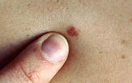 Ung thư từ nốt ruồi rất nguy hiểm, di căn nhanh: Những dấu hiệu của nốt ruồi cần cảnh giác