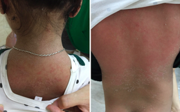 Mắc bệnh lạ, bé gái 3 tuổi ở Phú Thọ bỗng nhiên môi tều, bong tróc da toàn thân