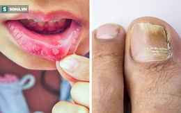 8 tác dụng phụ của kháng sinh mà ngay cả bác sĩ cũng không thường xuyên nói cho bạn biết