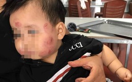 Bé 12 tháng tuổi bầm tím khắp người sau khi đi trẻ về