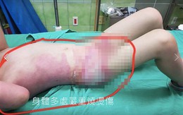 Con gái 5 tuổi bị bỏng nặng, kiểm tra camera trong trường mẫu giáo bố mẹ càng phẫn nộ hơn