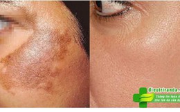 Nám da có chữa được không? Nhiều chị em tiền mất tật mang vì không tìm được câu trả lời