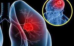 Tưởng viêm phổi lại hoá ung thư giai đoạn 4, người phụ nữ cảnh báo về 1 dấu hiệu cần chú ý