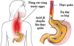 Chuyên gia Tiêu hóa BV Bạch Mai chia sẻ tư thế ngủ tốt cho dạ dày, tránh trào ngược