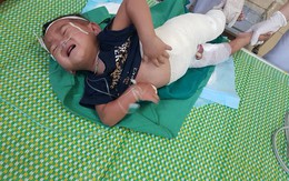 Ngã vào nồi măng, bé 2 tuổi bị bỏng toàn thân