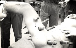 Robot trong nhà máy gặp 'trục trặc kỹ thuật', đâm 10 chiếc đinh tán xuyên người công nhân