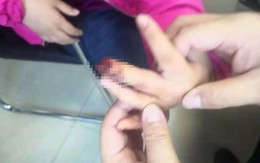 Bé gái 9 tuổi phải cưa ngón tay vì cách sơ cứu sai lầm của bà nội sau khi bị kẹt tay vào cửa
