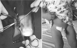 Chủ quan khi thấy "vùng kín" con lớn bất thường, 2 năm sau cha mẹ vội đưa con nhập viện
