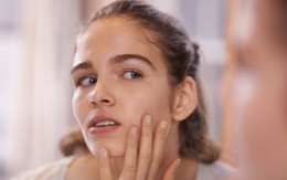 Đang bị mụn cần tránh làm 5 việc này để không làm tình trạng mụn thêm tồi tệ