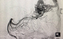 Cứu sống bệnh nhân bị dị dạng mạch máu não