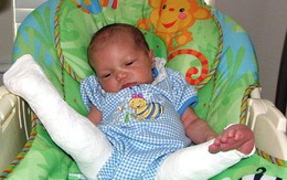 Sinh ra với đôi chân bị bẻ quặt ra phía trước, 8 năm sau, cô bé trở lại bệnh viện và khiến cho các bác sĩ tròn mắt kinh ngạc