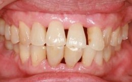 Vệ sinh răng miệng kém có thể gây ra ung thư phổi, ung thư đại tràng