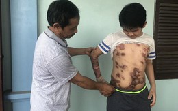 Nạn nhân 16 tuổi ám ảnh kinh hoàng về vụ cháy xưởng bánh kẹo