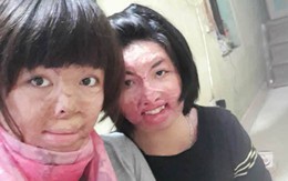 Nỗi niềm đồng cảm và nghị lực vượt lên số phận của 2 người phụ nữ bị chồng tẩm xăng đốt