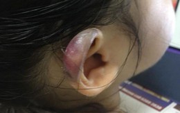 Đón con gái 3 tuổi từ nhà trẻ về, cha mẹ chết lặng khi phát hiện tai con bị sưng phồng biến dạng