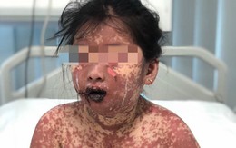Mắc hội chứng hiếm gặp, bé gái 7 tuổi ở Tiền Giang có làn da như bỏng nặng